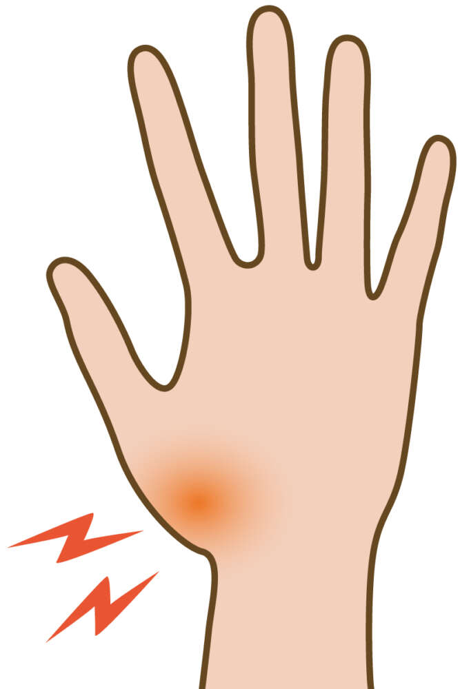 親指の付け根が痛い　母指CM関節症